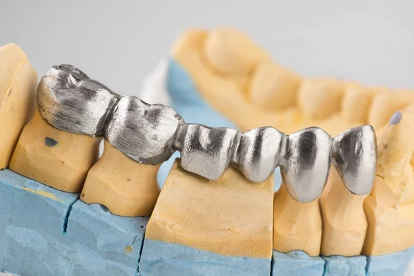 Corona Dental Artificial Acero Para Restauración Dentición — Foto de Stock