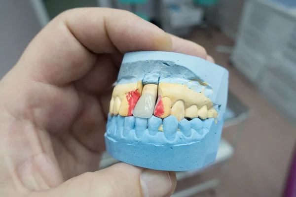 Dental Ceramic Metal Crowns Plaster Model Doctors Hand — Stock Photo, Image
