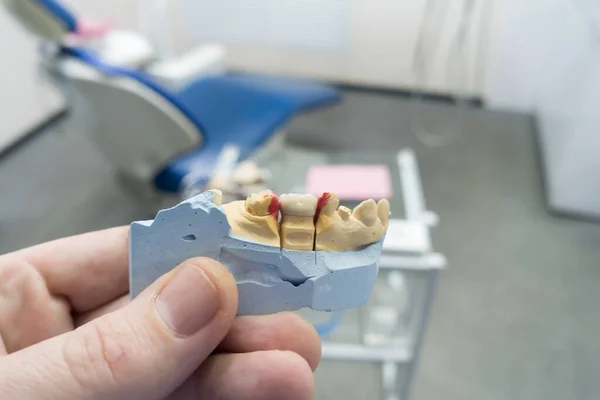 Korony Ceramiki Dentystycznej Modelu Gipsu Rękach Lekarzy — Zdjęcie stockowe