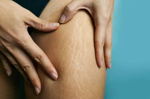 Smagliature Sulle Gambe Delle Donne Mano Femminile Tiene Cellulite Grassa — Foto Stock