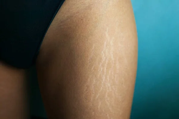 Stretch Marks On Woman's Legs. Female Hand Holds Fat Cellulite And Stretch Mark On Leg. Cellulite.