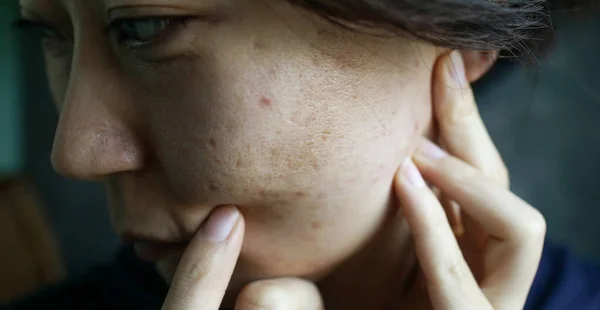 Young Asian Woman Concentrating She Squeezes Pimple Dalam Bahasa Inggris — Stok Foto