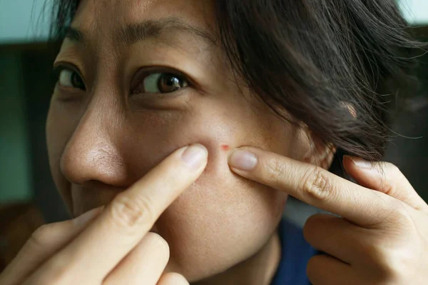 Young Asian Woman Concentrating She Squeezes Pimple Dalam Bahasa Inggris — Stok Foto