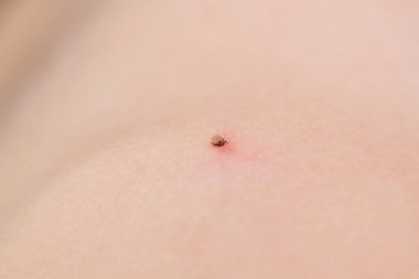 Ensefalit kene. Portre.