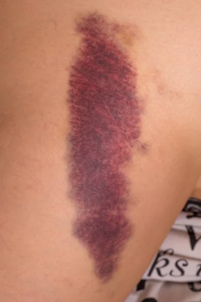 Hematom uylukta. İnişli çıkışlı bacak.