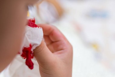 Çocuk burun kanamayı durdurmak için doku kullanma