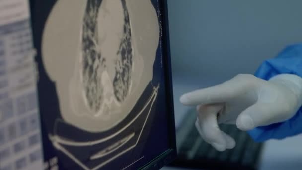 Bir insan akciğeri bir covid-19 ile nasıl görünür? — Stok video