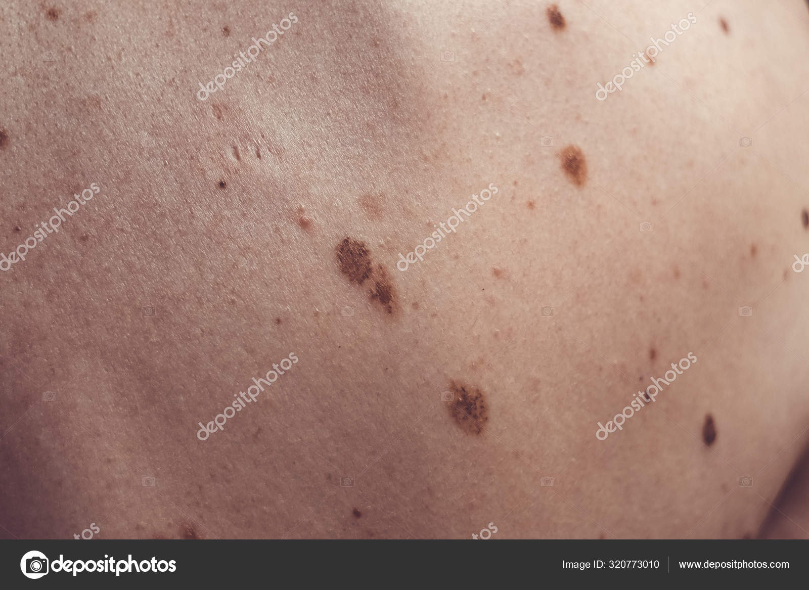 Nevus melanocítico, algunos de ellos displásicos o atípicos, en un hombre  caucásico de 37 años de España — Foto de stock © mikelju #320773010, image size:1600x1167