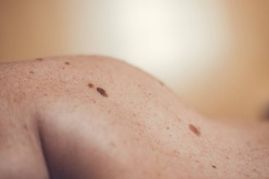 Melanositik nevus, bazıları displastik ya da atipik, İspanya 'dan gelen 37 yaşındaki beyaz bir adam üzerinde.