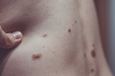 Melanositik nevus, bazıları displastik ya da atipik, İspanya 'dan gelen 37 yaşındaki beyaz bir adam üzerinde.