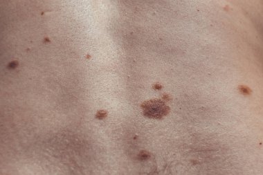 Melanositik nevus, bazıları displastik ya da atipik, İspanya 'dan gelen 37 yaşındaki beyaz bir adam üzerinde.
