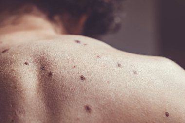 Melanositik nevus, bazıları displastik ya da atipik, İspanya 'dan gelen 37 yaşındaki beyaz bir adam üzerinde.