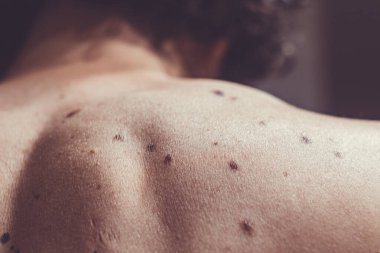 Melanositik nevus, bazıları displastik ya da atipik, İspanya 'dan gelen 37 yaşındaki beyaz bir adam üzerinde.