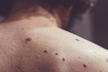 Melanositik nevus, bazıları displastik ya da atipik, İspanya 'dan gelen 37 yaşındaki beyaz bir adam üzerinde.
