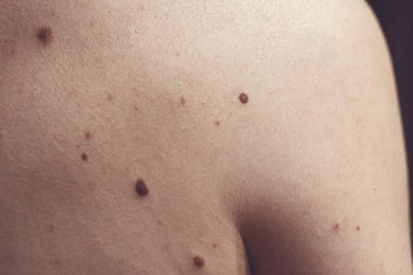 Melanositik nevus, bazıları displastik ya da atipik, İspanya 'dan gelen 37 yaşındaki beyaz bir adam üzerinde.