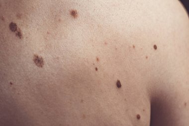 Melanositik nevus, bazıları displastik ya da atipik, İspanya 'dan gelen 37 yaşındaki beyaz bir adam üzerinde.