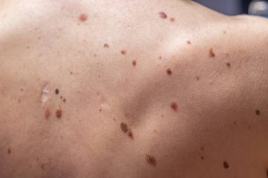 Melanositik nevus, bazıları displastik ya da atipik, İspanya 'dan gelen 37 yaşındaki beyaz bir adam üzerinde.