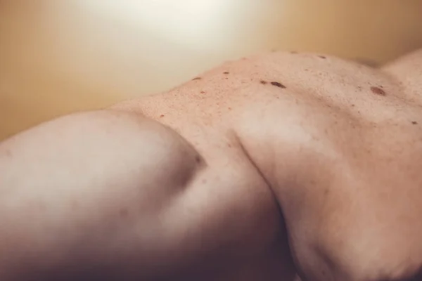 Nevus melanocítico, algunos de ellos displásicos o atípicos, en un hombre caucásico de 37 años de España — Foto de Stock