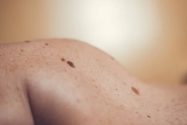 Melanocytární nevus, některé z nich dyplastické nebo atypické, na bělocha 37 let, ze Španělska — Stock fotografie