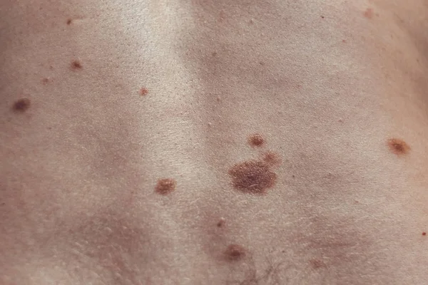 来自西班牙的一个37岁的高加索人身上的黑色素瘤状的痣，其中一些是畸形或非典型的 — 图库照片