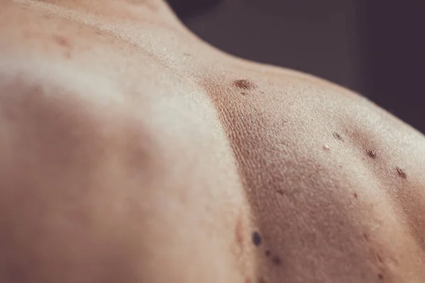 Nevus melanocítico, algunos de ellos displásicos o atípicos, en un hombre caucásico de 37 años de España — Foto de Stock