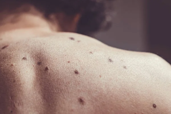 Melanositik nevus, bazıları displastik ya da atipik, İspanya 'dan gelen 37 yaşındaki beyaz bir adam üzerinde.