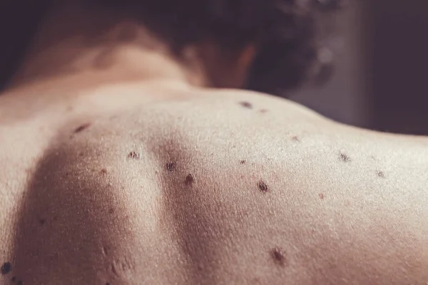 Melanositik nevus, bazıları displastik ya da atipik, İspanya 'dan gelen 37 yaşındaki beyaz bir adam üzerinde.