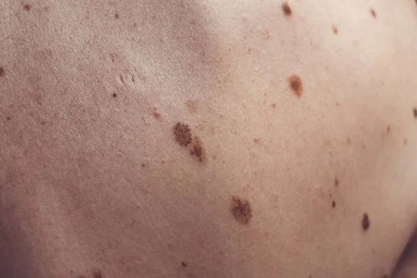 来自西班牙的一个37岁的高加索人身上的黑色素瘤状的痣，其中一些是畸形或非典型的 — 图库照片