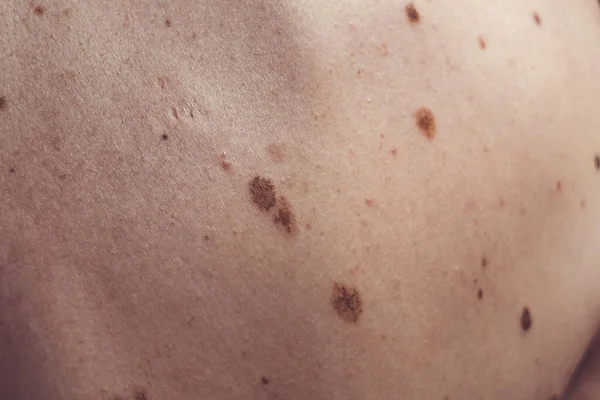 Melanositik nevus, bazıları displastik ya da atipik, İspanya 'dan gelen 37 yaşındaki beyaz bir adam üzerinde.