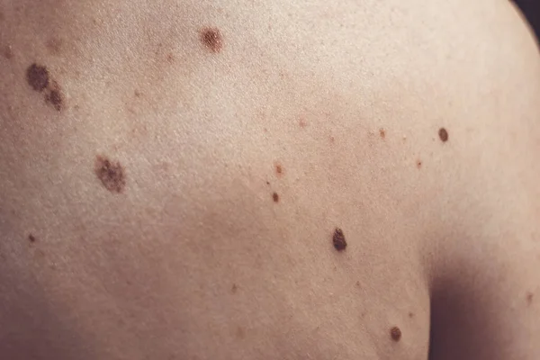 Melanocytic nevus, niektóre z nich dyplastic lub atypowe, na białym mężczyźnie 37 lat z Hiszpanii — Zdjęcie stockowe