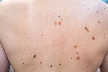 Melanositik nevus, bazıları displastik ya da atipik, İspanya 'dan gelen 37 yaşındaki beyaz bir adam üzerinde.