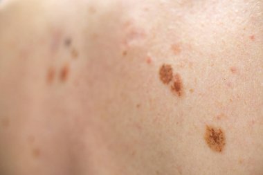 Melanositik nevus, bazıları displastik ya da atipik, İspanya 'dan gelen 37 yaşındaki beyaz bir adam üzerinde.