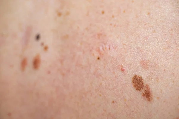 Melanocytic nevus, some of them dyplastic or atypical, on a caucasian man of 37 years old from Spain — Stock Photo, Image