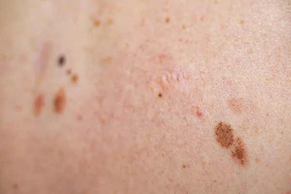 Melanocytic nevus, néhány közülük dyplasticus vagy atípusos, egy fehér férfi 37 éves Spanyolországból — Stock Fotó