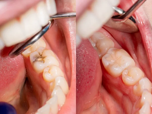 Cáries e doenças dentárias. Enchimento com um fótopo composto dental — Fotografia de Stock