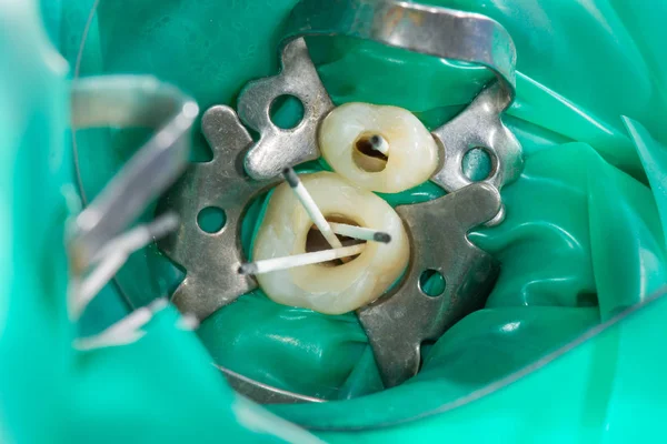 Human tooth close-up macro. Endodontics treatment of canals and — Stock Photo, Image