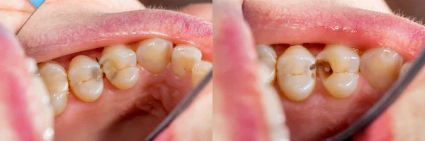 Two chewing side teeth of the upper jaw after treatment of carie — Stock Photo, Image