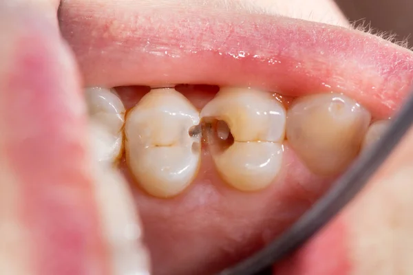 Caries and tooth disease. Filling with a dental composite photop — Stock Photo, Image