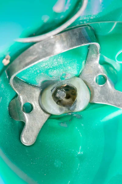 歯の閉鎖の内因性治療.根の掃除 — ストック写真