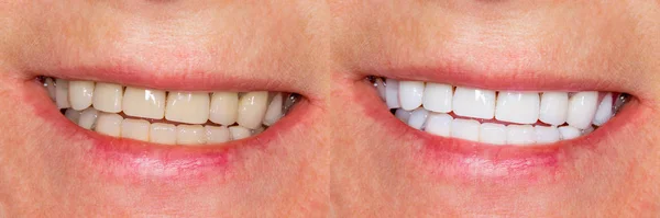 Chapas dentales, coronas de cerámica antes y después del tratamiento. Cierre — Foto de Stock