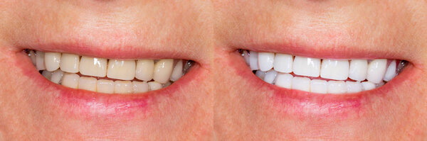 Dental veneers, ceramic crowns before and after treatment. Close