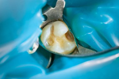 Carie tedaviden sonra üst çenenin iki diş çiğnemesi