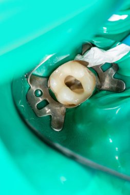 Alt azı dişlerindeki diş kanallarının fotoğraf endodontik tedavisi