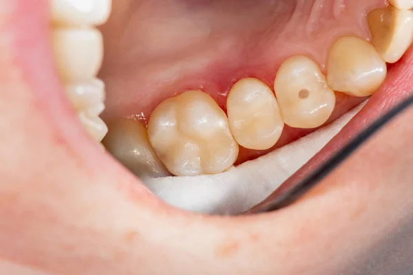 Dois dentes laterais de mastigação da mandíbula superior após o tratamento de cárie — Fotografia de Stock