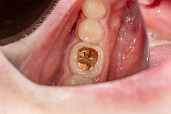 Karies och tandsjukdom. Fyllning med en fotop av dentalt komposit — Stockfoto
