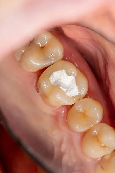 Tratamiento de las raíces del diente. Sellado y limpieza de un cari — Foto de Stock