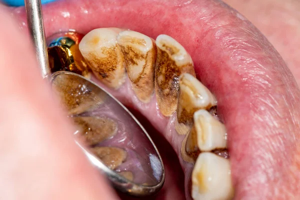 Close-up de cálculo macrodental e placa dentária. Higiene oral — Fotografia de Stock