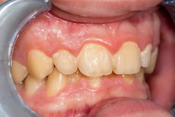 Πλάκας του ασθενούς, πέτρα. Οδοντιατρική θεραπεία της οδοντικής plaq — Φωτογραφία Αρχείου