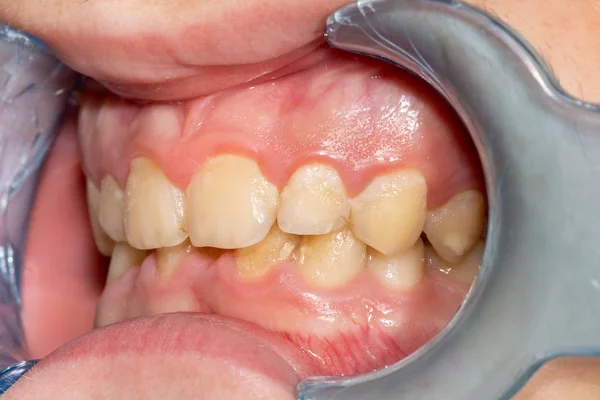 Gros plan sur le calcul macrodentaire et la plaque dentaire. Hygiène orale — Photo