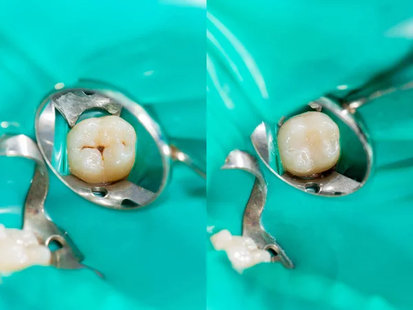 Zubní kaz. Plnění stomatologickým kompozitním fotopolymerem materi Royalty Free Stock Obrázky
